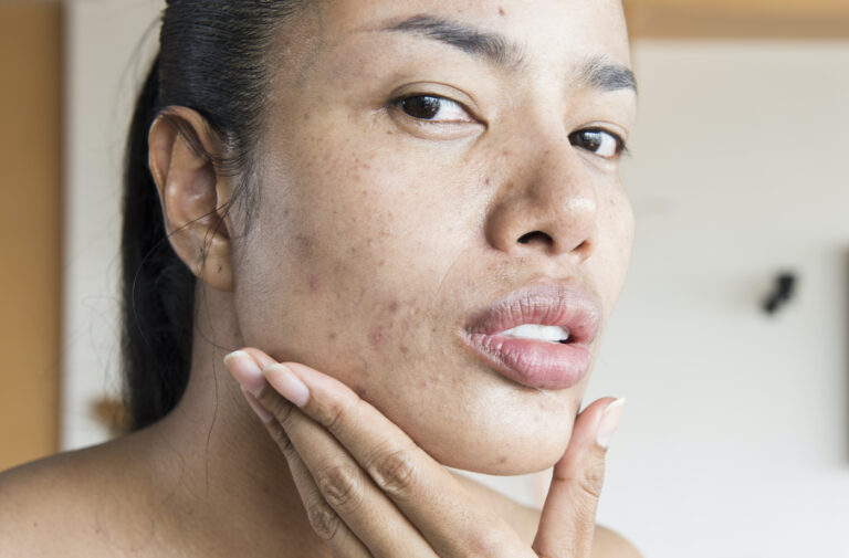 Is It OK To Have Pimples When Using Rejuvenating Set?