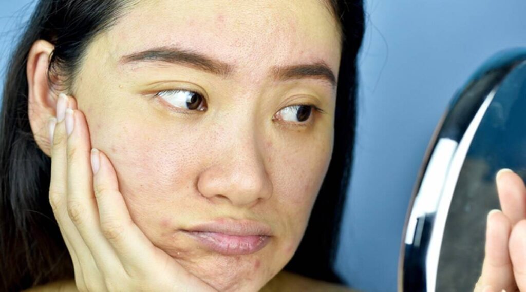 Rejuvenating Set Treats Pimples